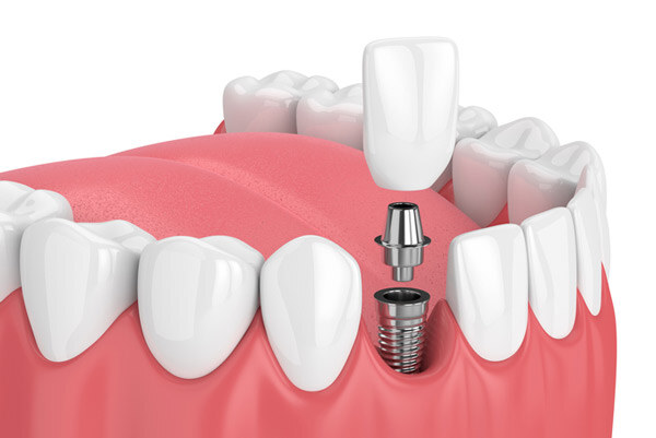 dental-implant