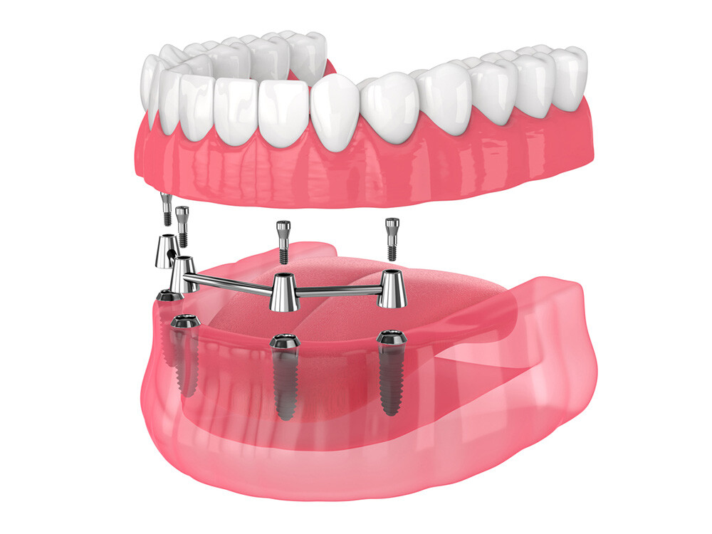 All-On-4-Dental-Implant-Service